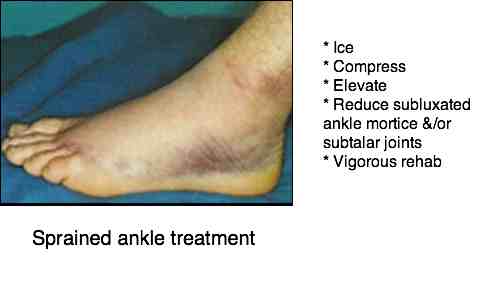 Sprained_ankle_treatment.jpg