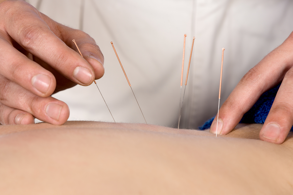 weight loss through acupuncture used by your chiropractor in omaha 