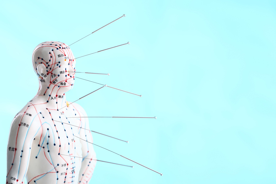 Acupuncture for Stress Relief 