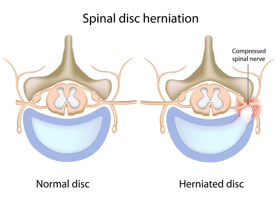 Disc herniation treatment