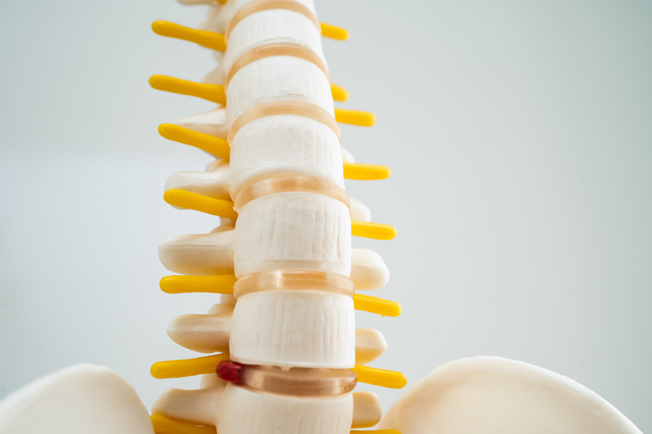Lumbar spine displaced herniated disc fragment bone artificial model