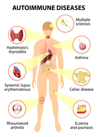 autoimmune diseases chart