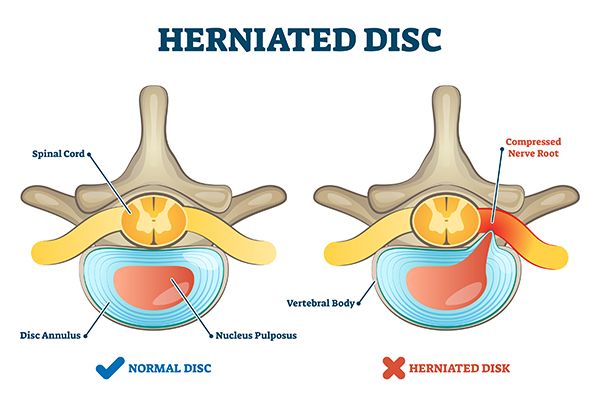 Side by side comparison of a normal disc and a herniated disc