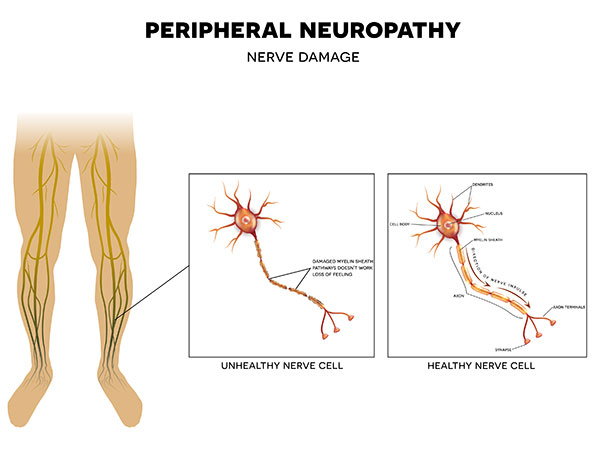 Peripheral Neuropathy graphic showing healthy nerve cell and damaged nerve cell