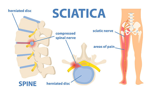 Sciatica graphic representing herniated disc, sciatic nerve and areas of pain