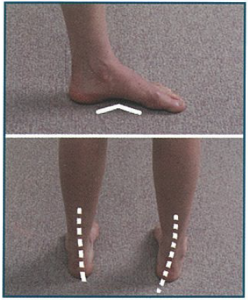 Figure 6. Supinated, high-arched foot