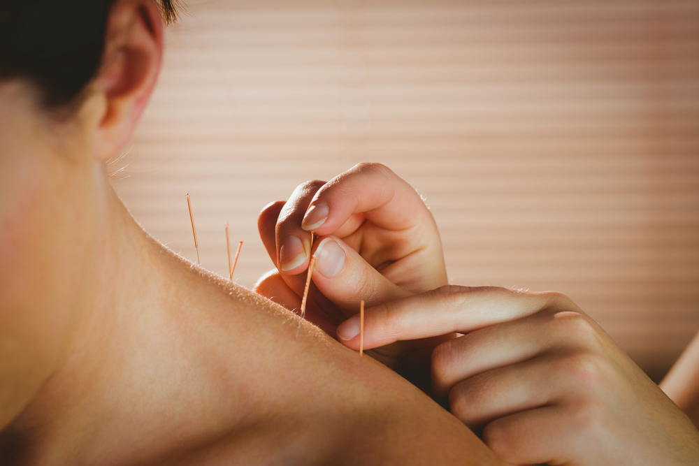 female patient receiving acupuncture treatment on her neck
