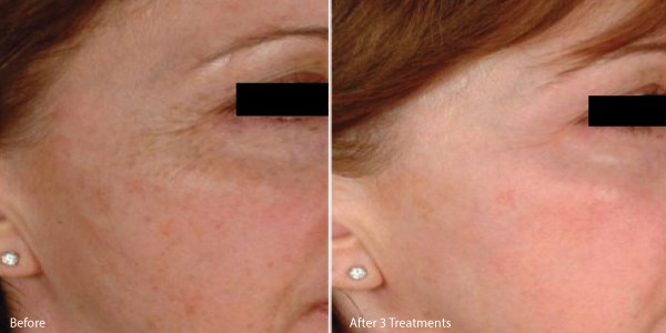 micorneedling before and after