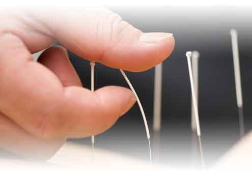 Acupuncture Ellisville