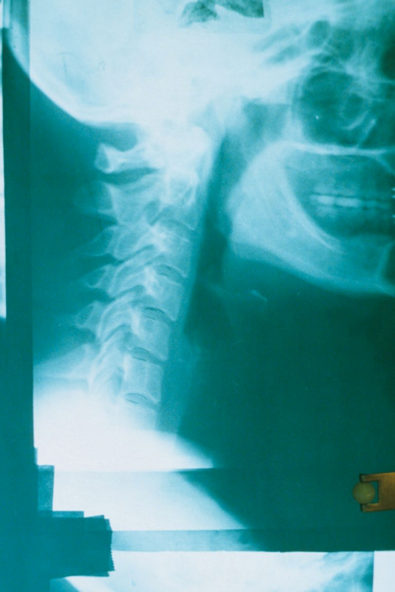 X-ray Neck disc degeneration