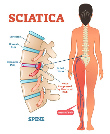 Illustration of sciatica