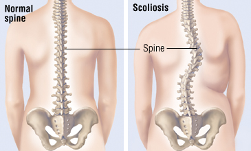 chiropractic for scoliosis