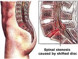 stenosis_and_discs.jpg