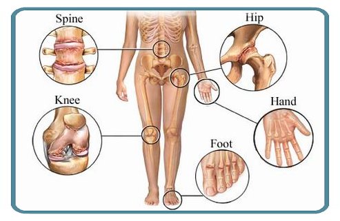 Living with Osteoarthritis: An Overview