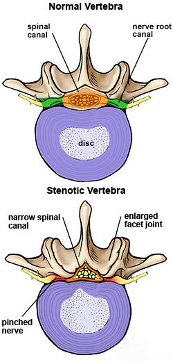 Stenosis Figure1_1.jpg
