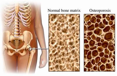 osteoporosischirobozeman