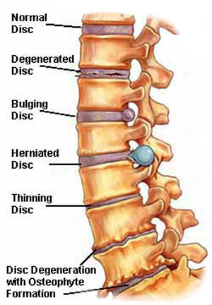 spine1 Low Back Pain Relief in Clearwater