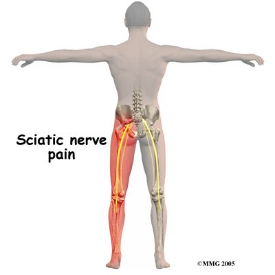 Sciatic nerve pain