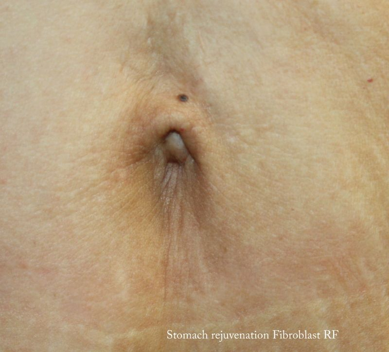 Fibroblast Stomach after