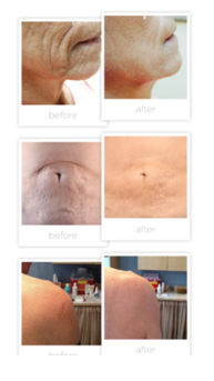 Microneedling 2