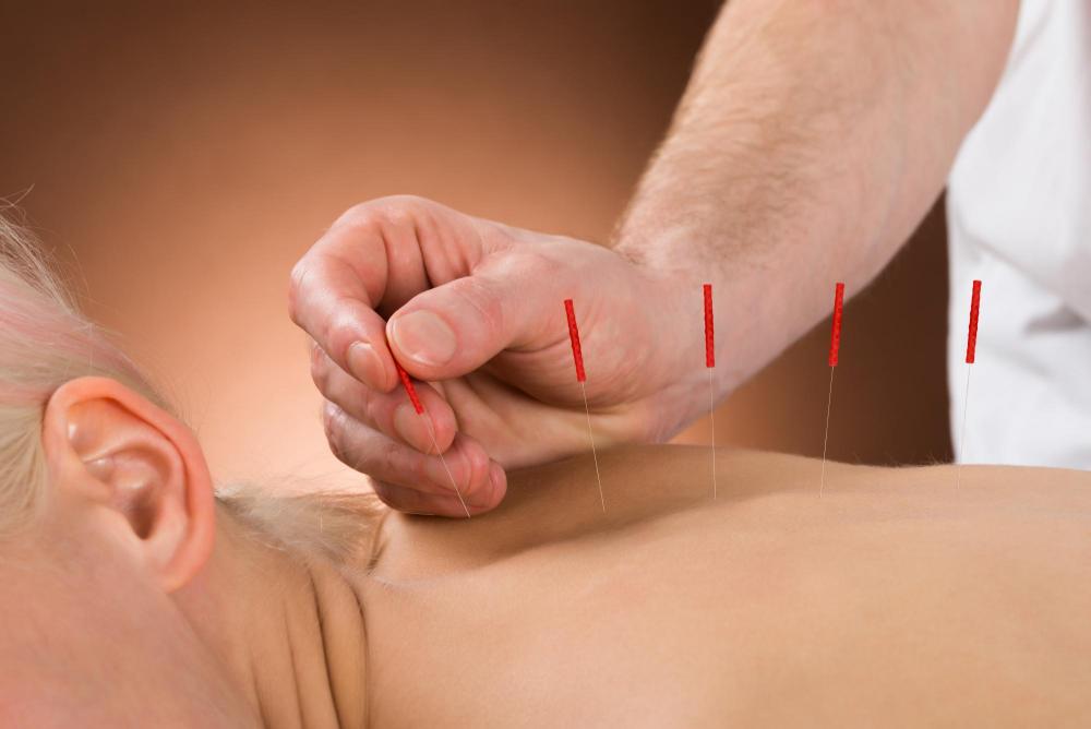 Man getting acupuncture