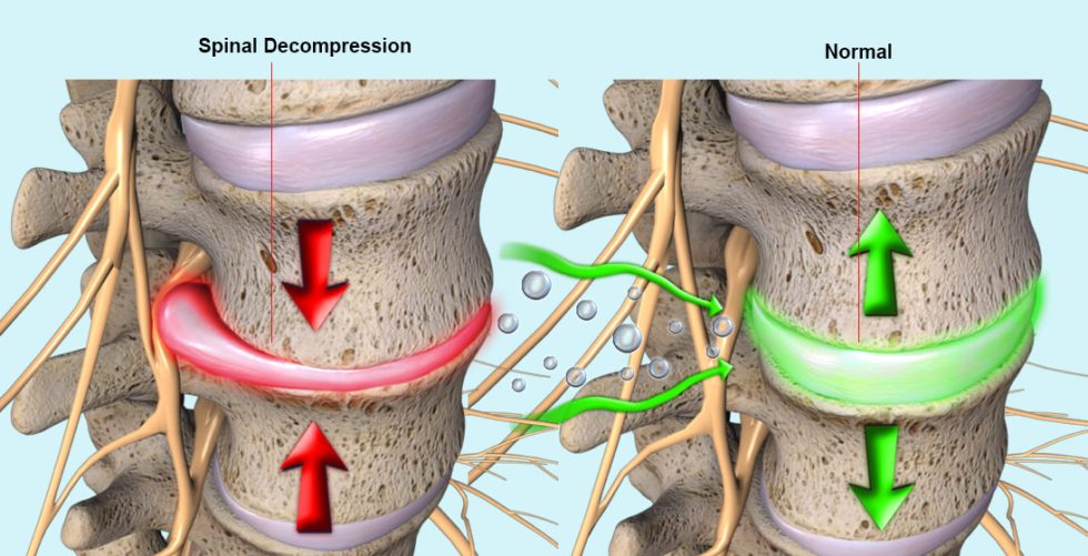 spine decompression