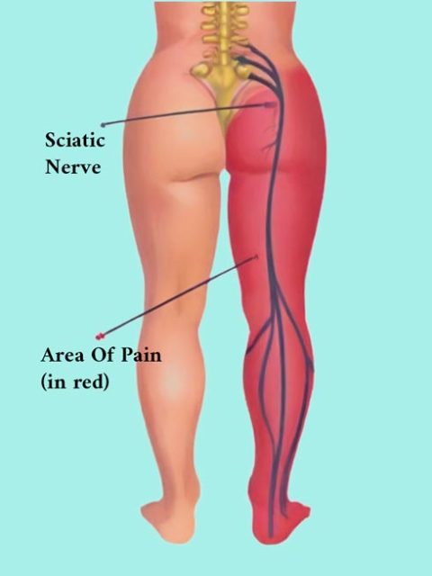 sciatica