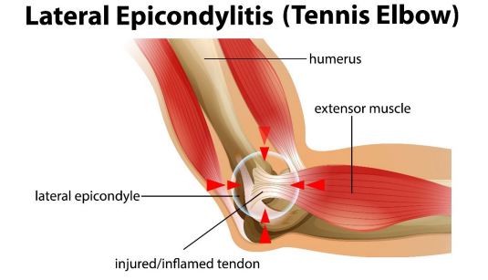 Tennis Elbow