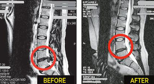 Spinal Decompression Therapy